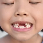 Child smiling with missing front teeth during growth stage
