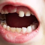 Close-up of child teeth with visible decay and cavities