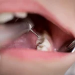 Dentist treating cavity in baby tooth with dental drill