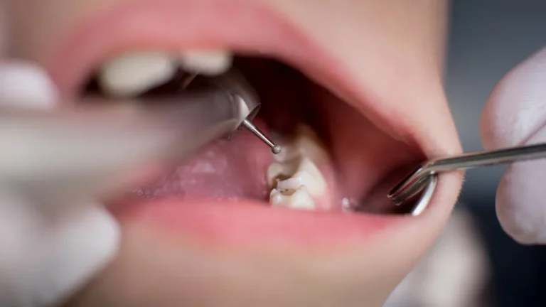 Dentist treating cavity in baby tooth with dental drill