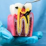 Cross-section tooth model showing pulp area for pulpotomy treatment
