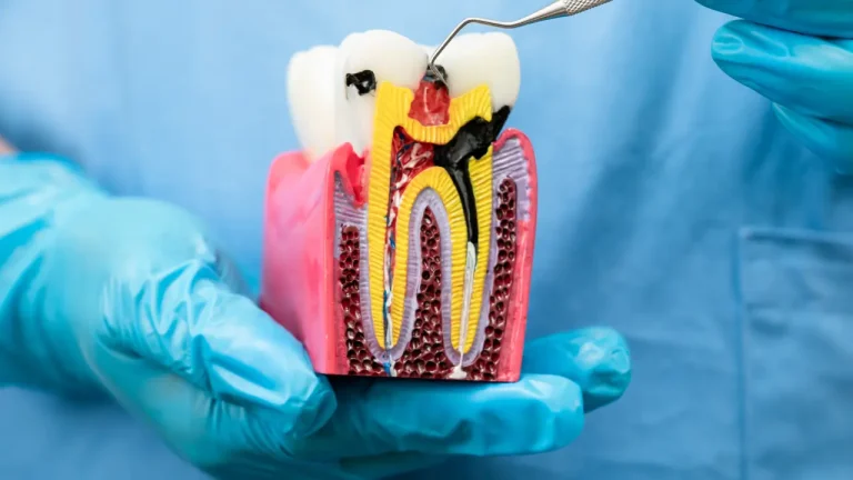 Cross-section tooth model showing pulp area for pulpotomy treatment