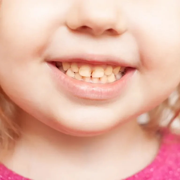 Close-up of child teeth with visible brown discoloration