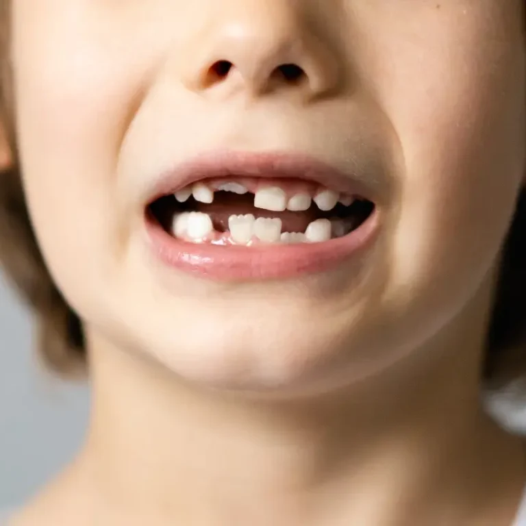 Close-up of child smiling with chipped front teeth